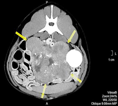 Surgical Excision of an Adrenal Neuroblastoma in a Dog